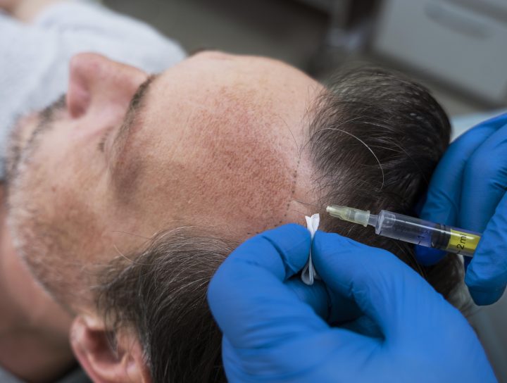 Hair Transplant Maintenance