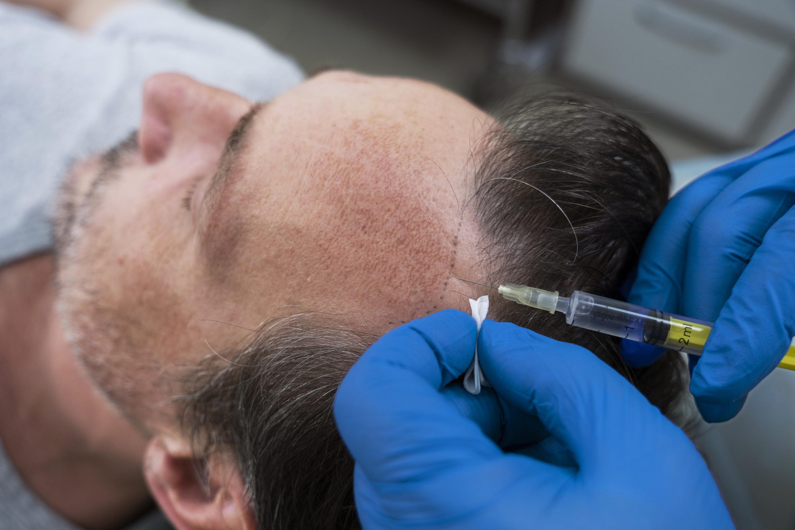 Hair Transplant Maintenance